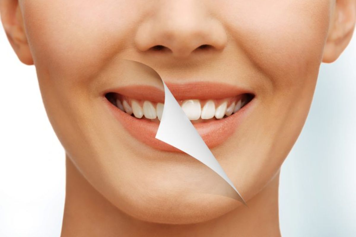 Clareamento Dental Sensibilidade Dental